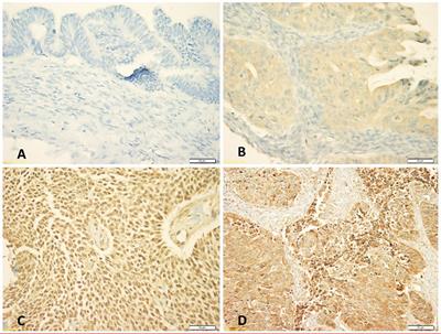 High N-Cadherin Protein Expression in Ovarian Cancer Predicts Poor Survival and Triggers Cell Invasion